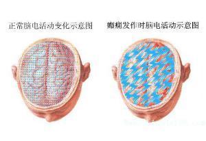 癲癇,是兒童時期最常見的一種良性部分性
