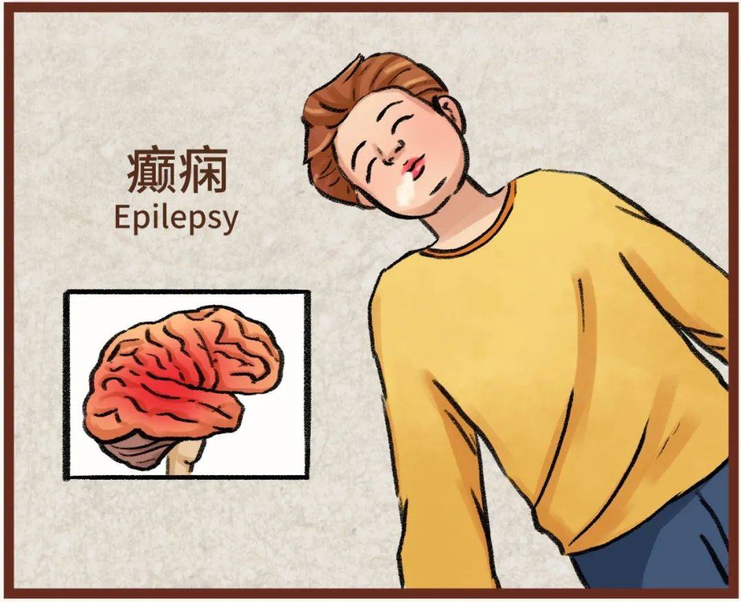 癲癇能治嗎?答案在這里!